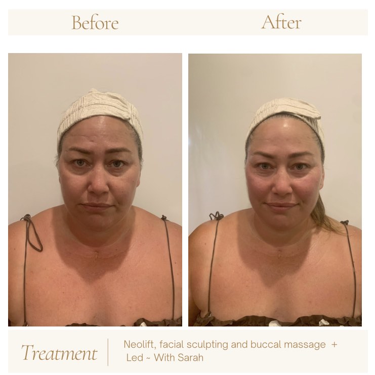 Inner Light ~ Neolift, facial sculpt and Buccal Massage. The facial everyone is asking for has arrived at Kinder Life.